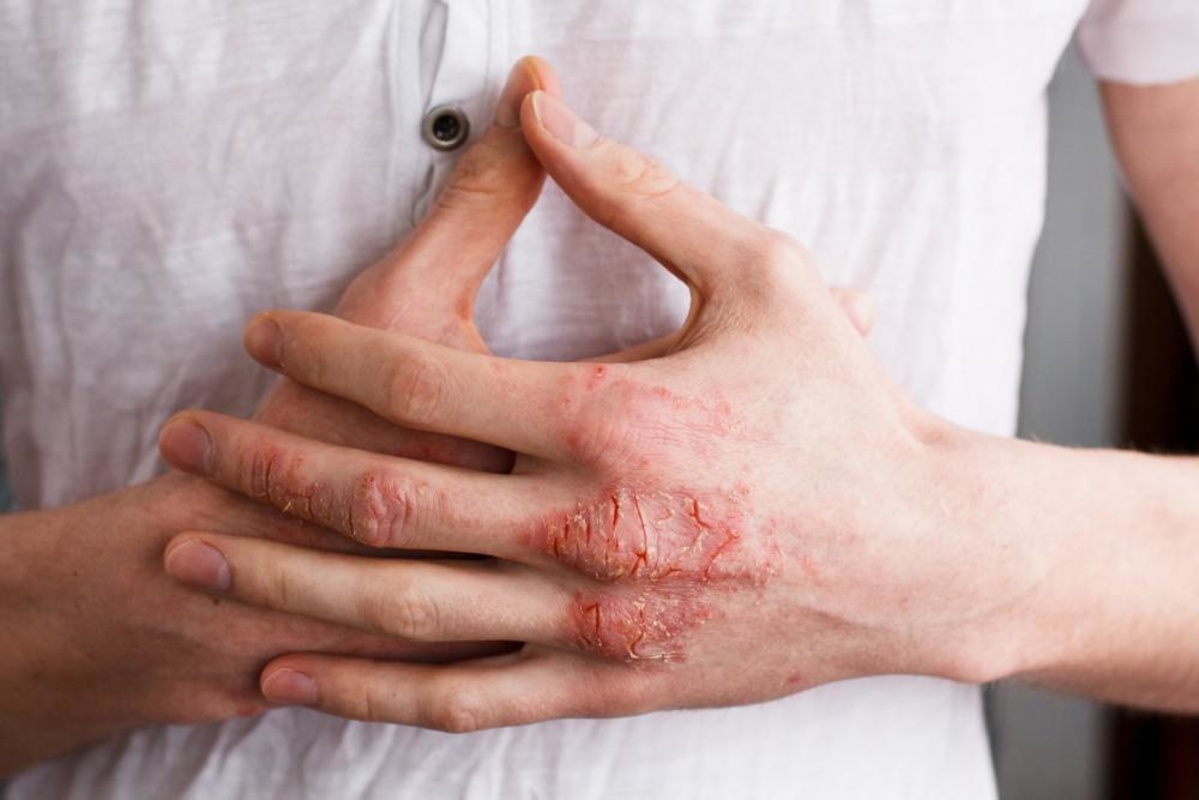 аллергический дерматит на руках
