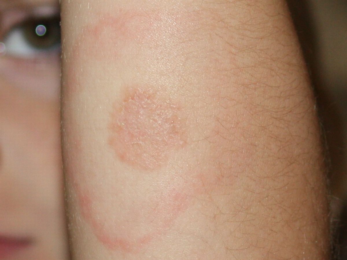 Lyme Disease Rash on 5 year old
