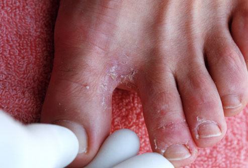 грибок пальцев на ногах