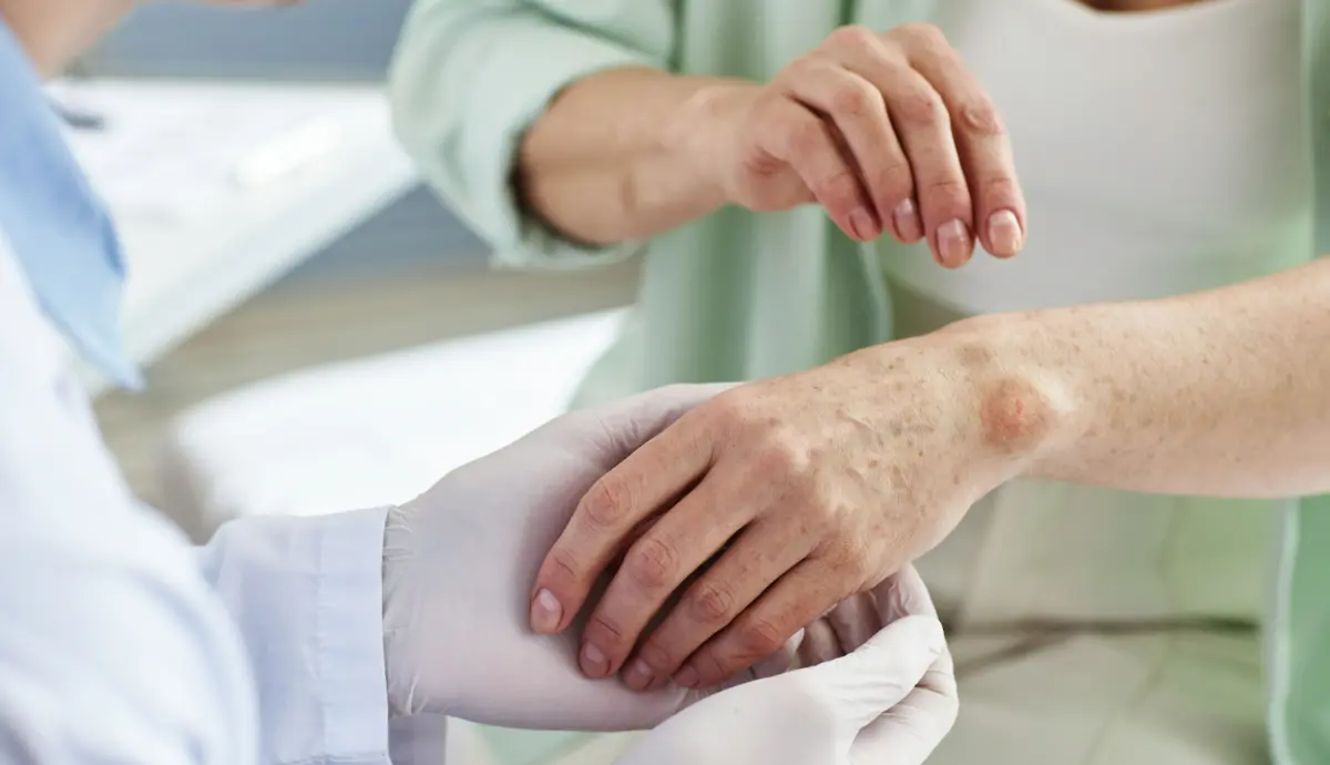 Забута хвороба повертається? Що відомо про нові випадки прокази в Європі