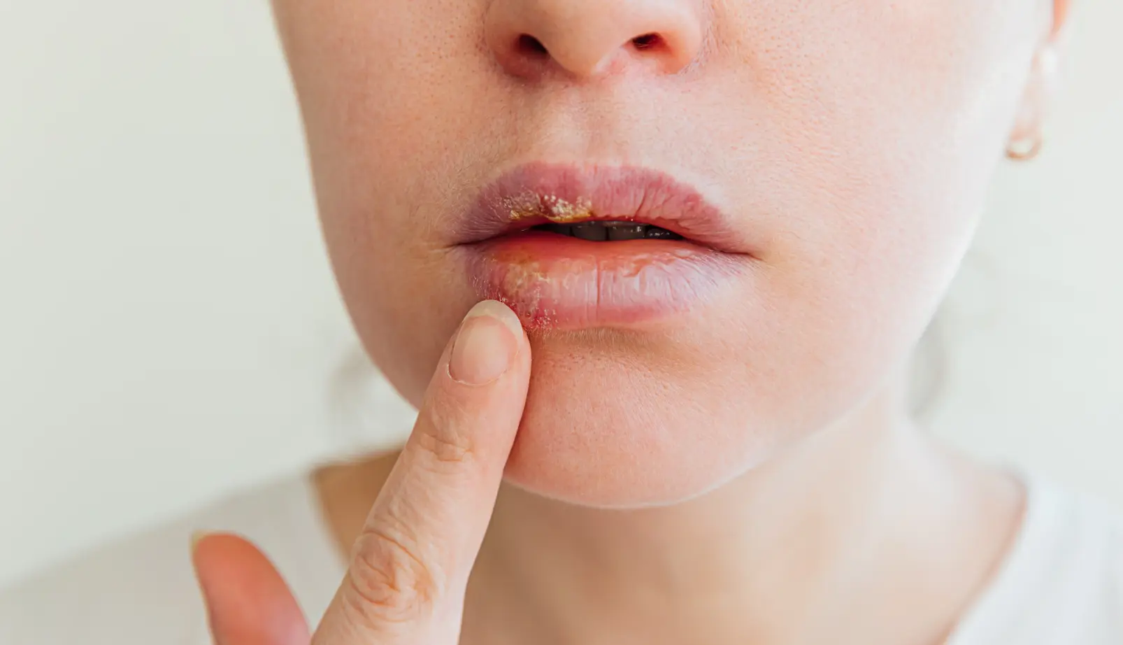 Чи справді герпес є майже у всіх? І що важливо знати про герпес