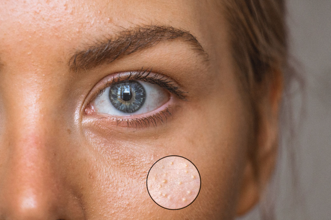 Белые точки на лице (милиумы) - как избавиться от угрей, причины появления просянки, лечение кожи