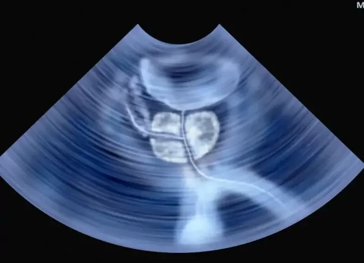 УЗИ простаты: когда назначается и как к нему подготовиться?