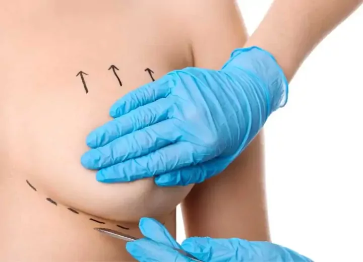 Подтяжка груди (мастопексия): кому показана и как проходит