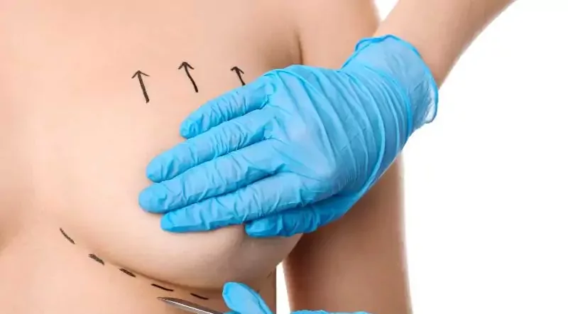 Підтяжка грудей (мастопексія): кому показана та як проходить
