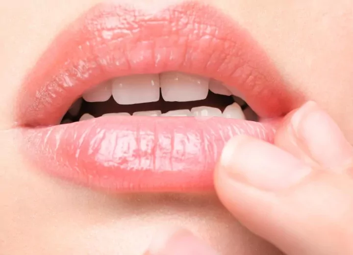 Как вылечить заеды в уголках рта (угловой хейлит)?