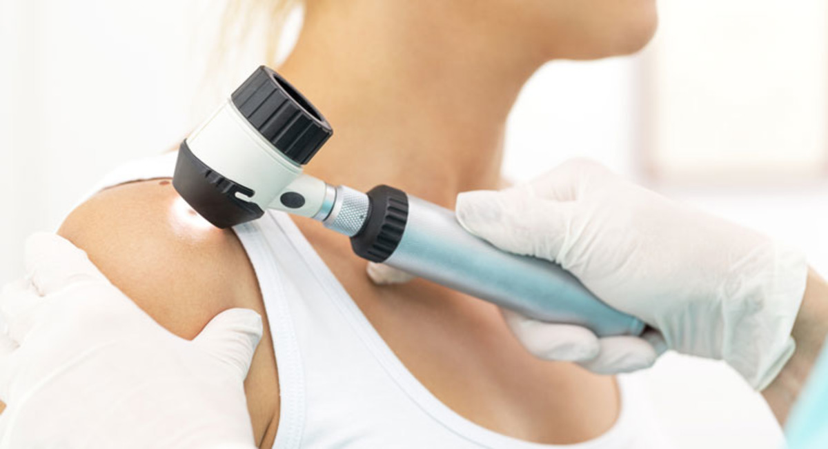 Що таке блакитний невус та чи потрібно його видаляти?