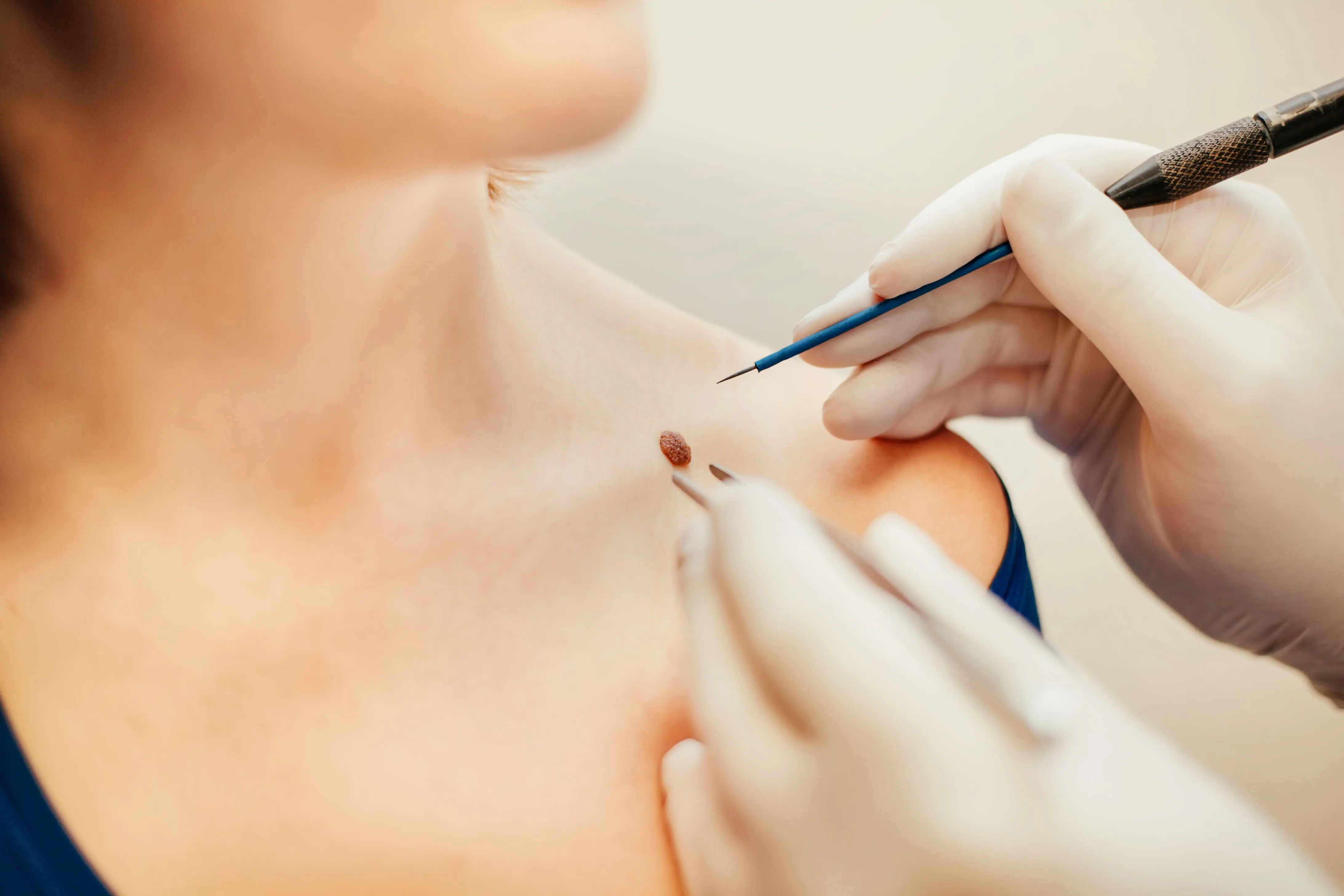 Як розпізнати ранні симптоми раку шкіри та як його лікувати?