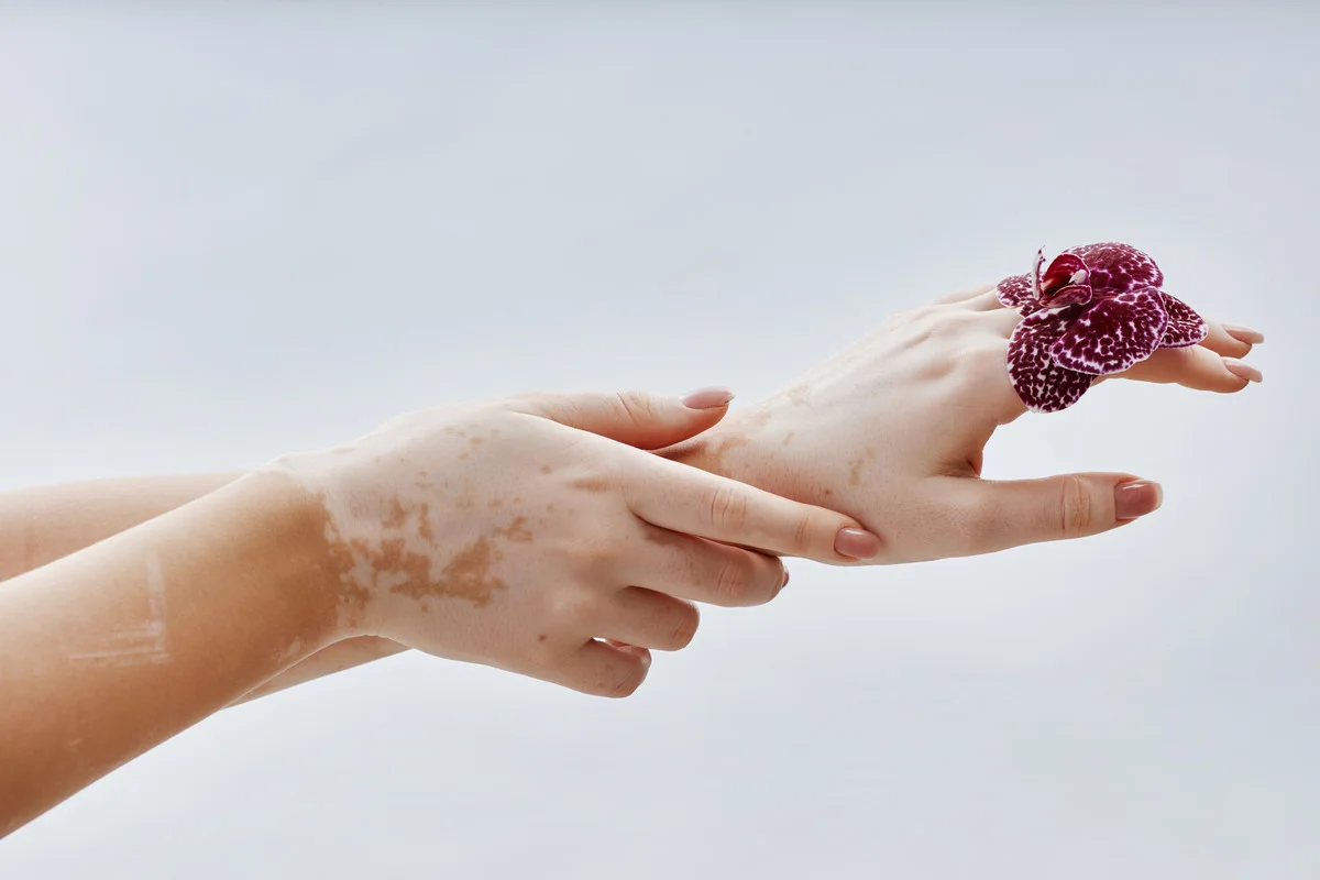 Что такое витилиго и как его лечат у детей и взрослых?