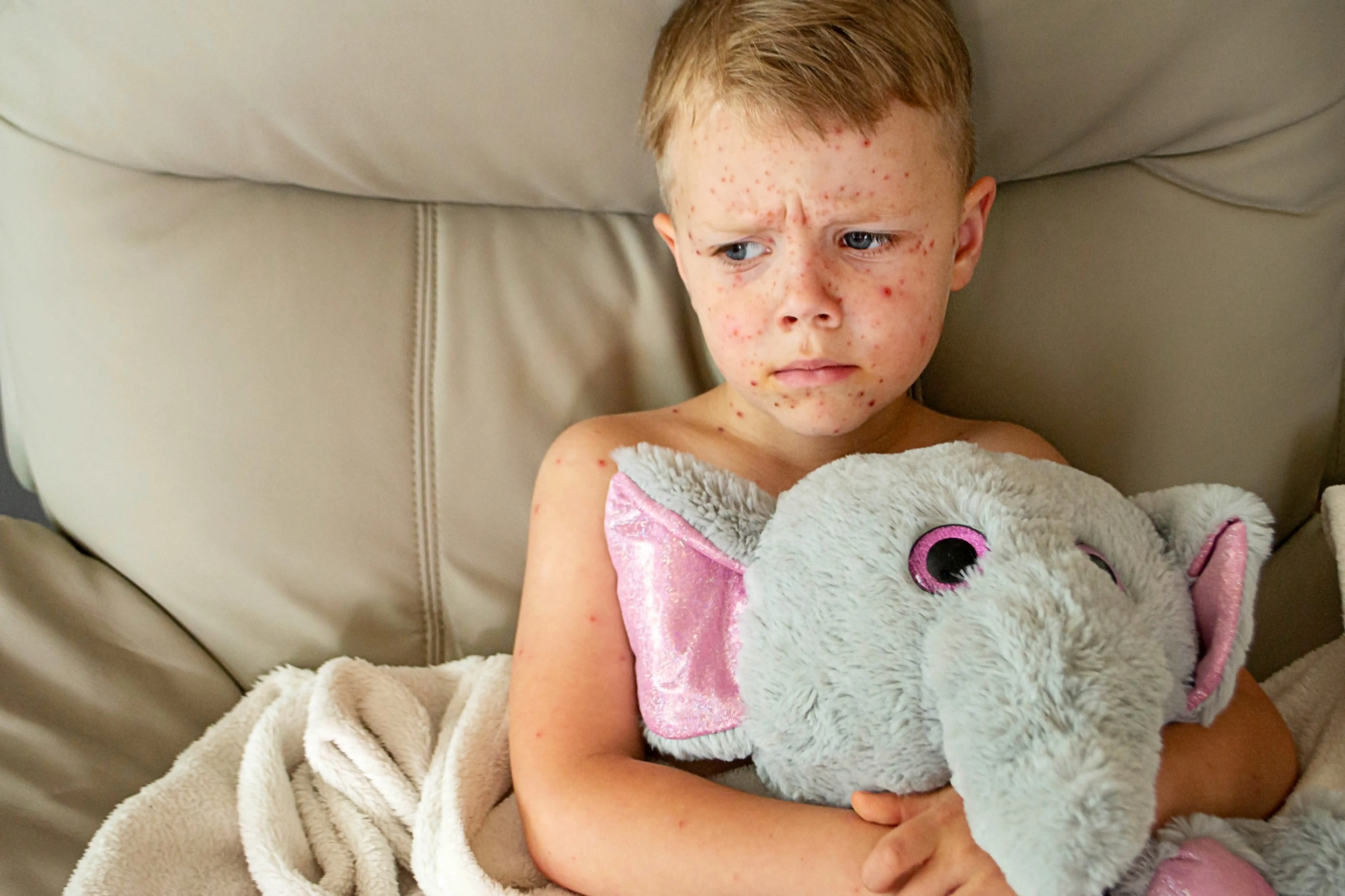 Стрептодермія (імпетиго) у дітей та дорослих