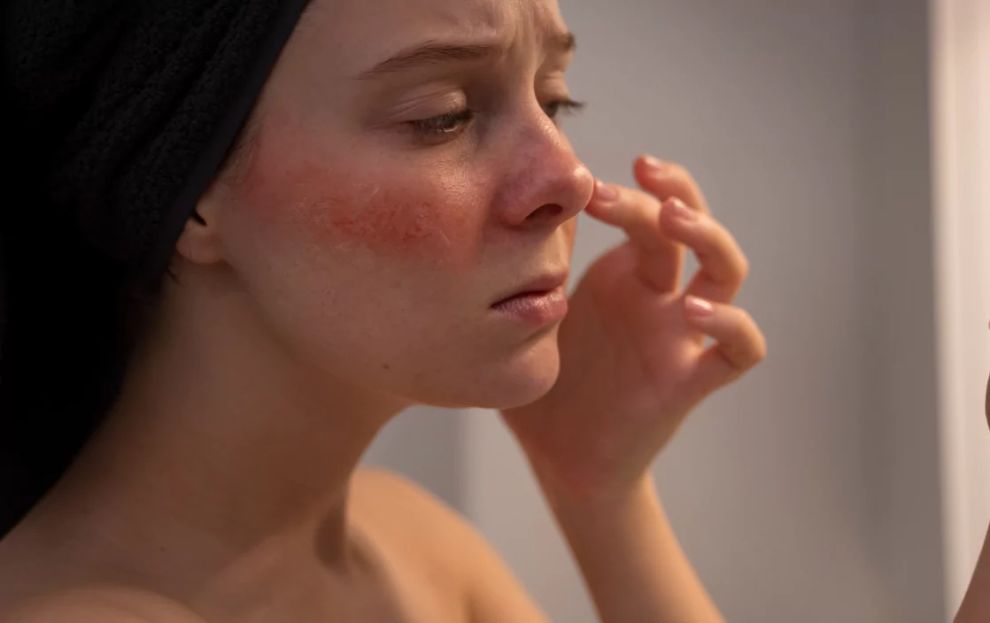 Аллергия на алкоголь: как она проявляется и что с ней делать?