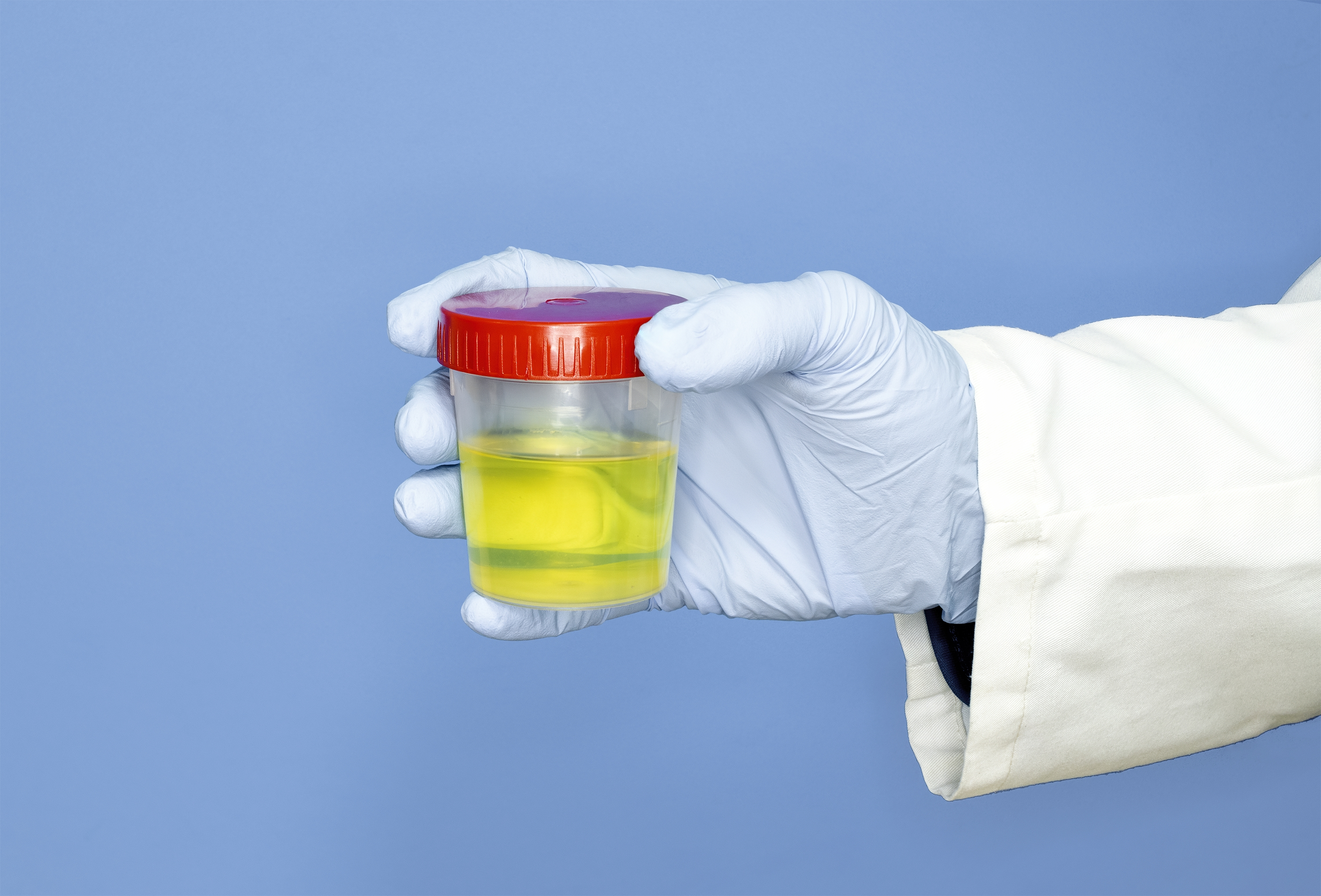 Бактерии в моче (бактериурия): симптомы, причины и методы лечения