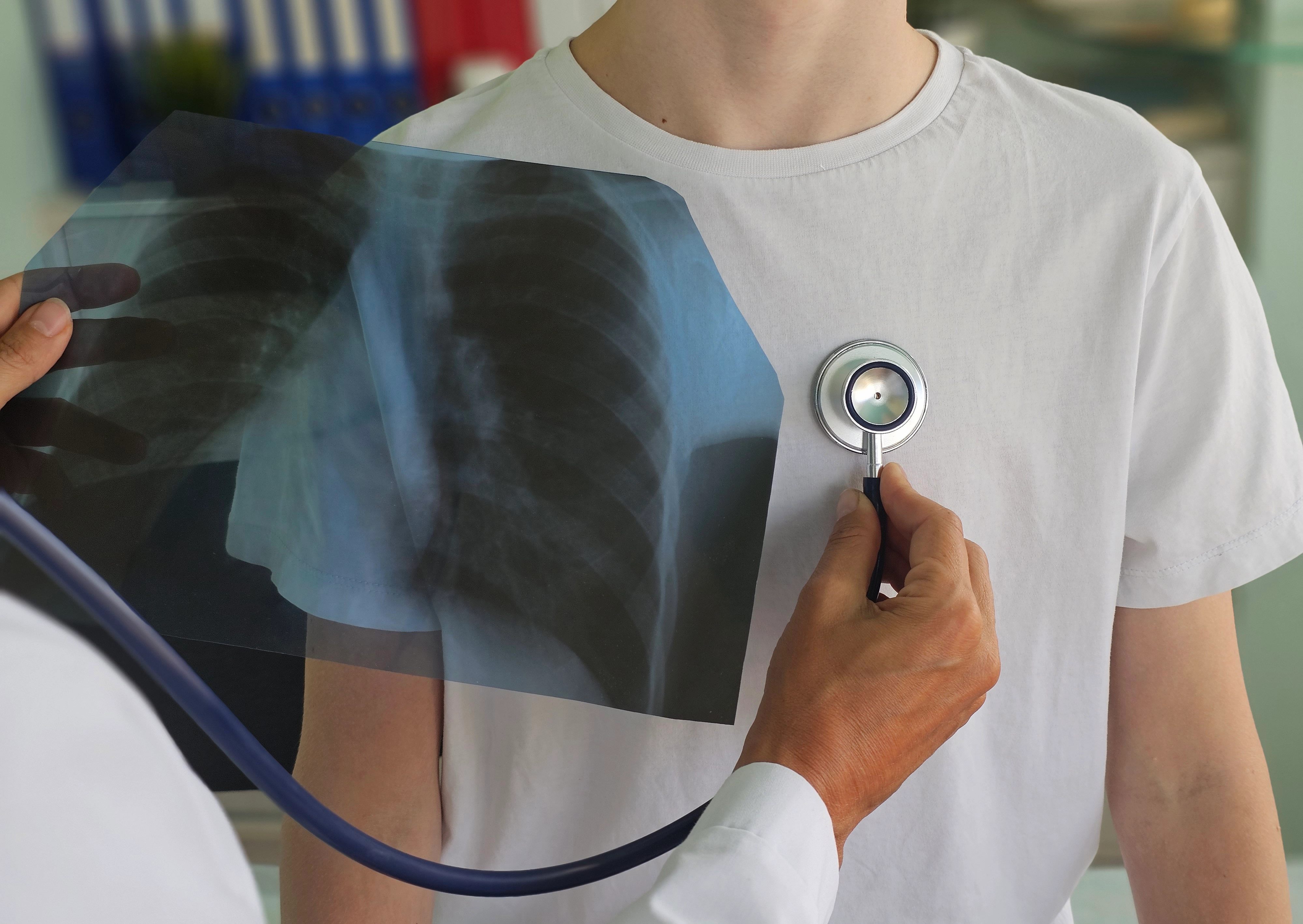 Туберкулез: симптомы, причины и лечение