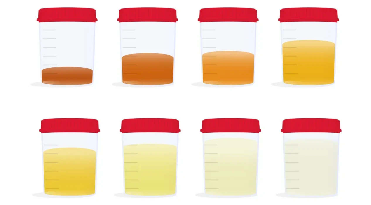 Цвет мочи и заболевания. Какие изменения могут быть сигналом отклонений?