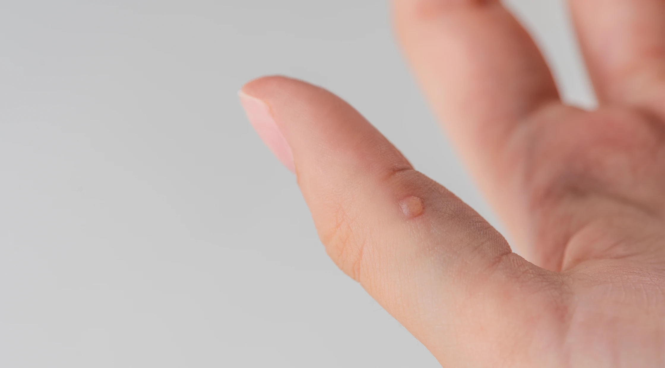 Як позбутися бородавок на руках?