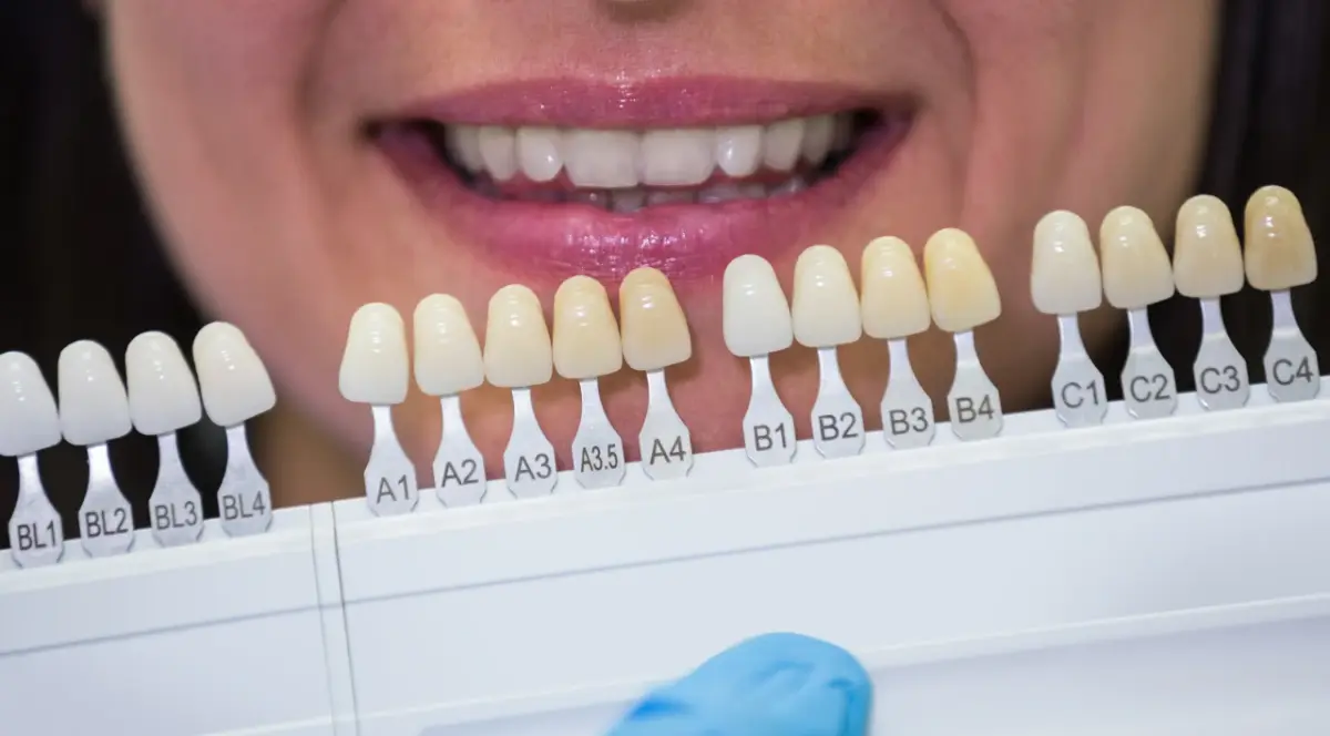 Что такое виниры: какие бывают, преимущества и риски для зубов