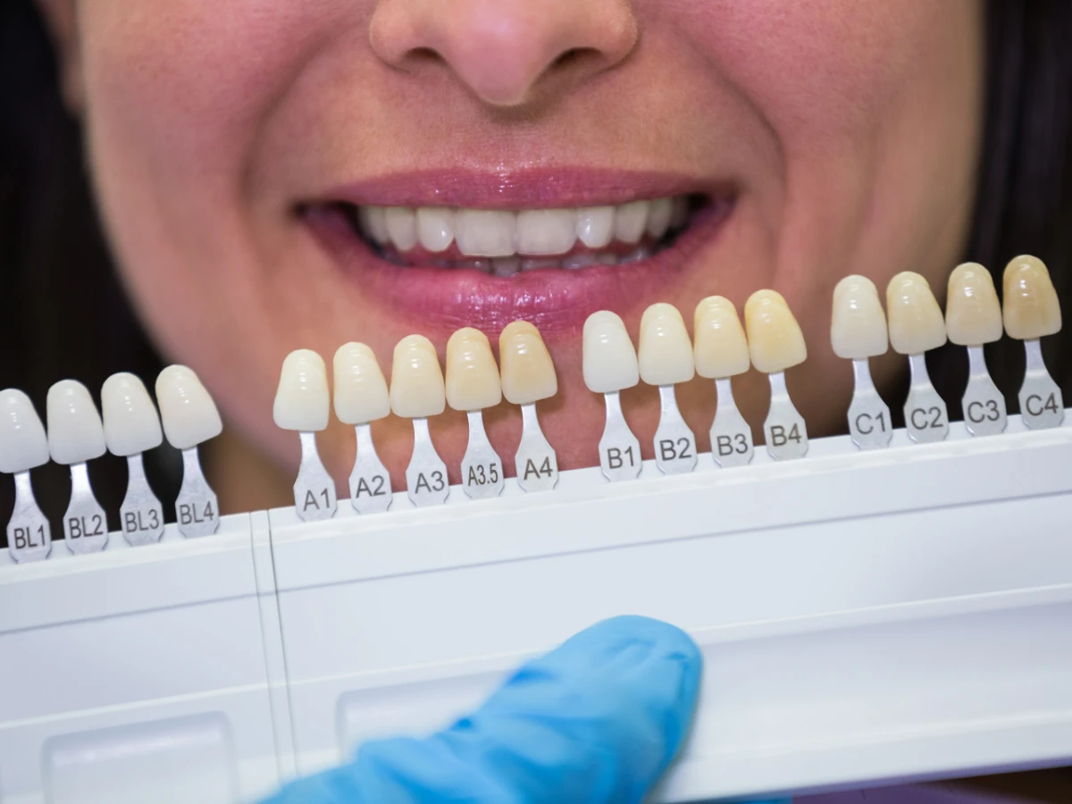 Что такое виниры: какие бывают, преимущества и риски для зубов