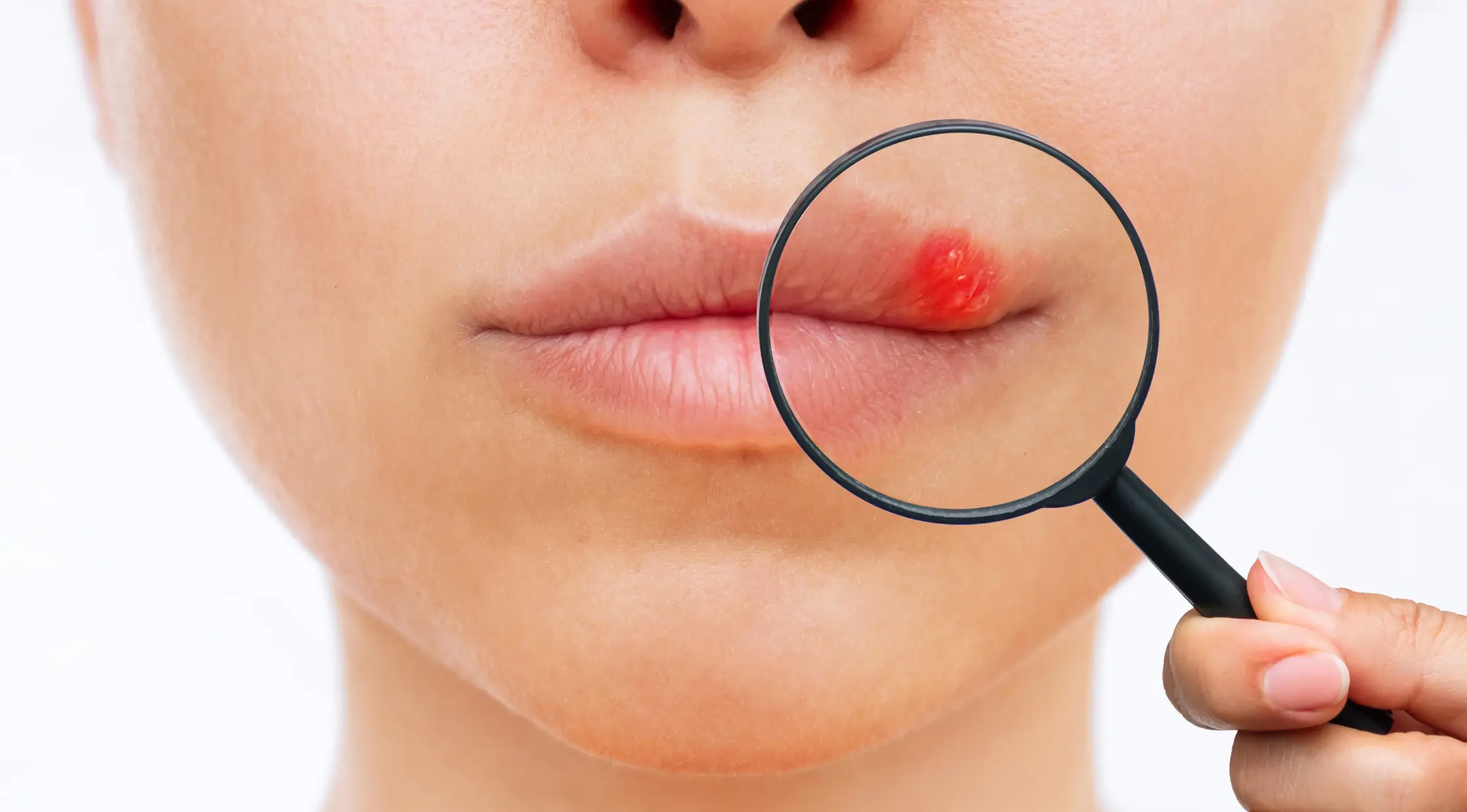 Чи справді герпес є майже у всіх? І що важливо знати про герпес