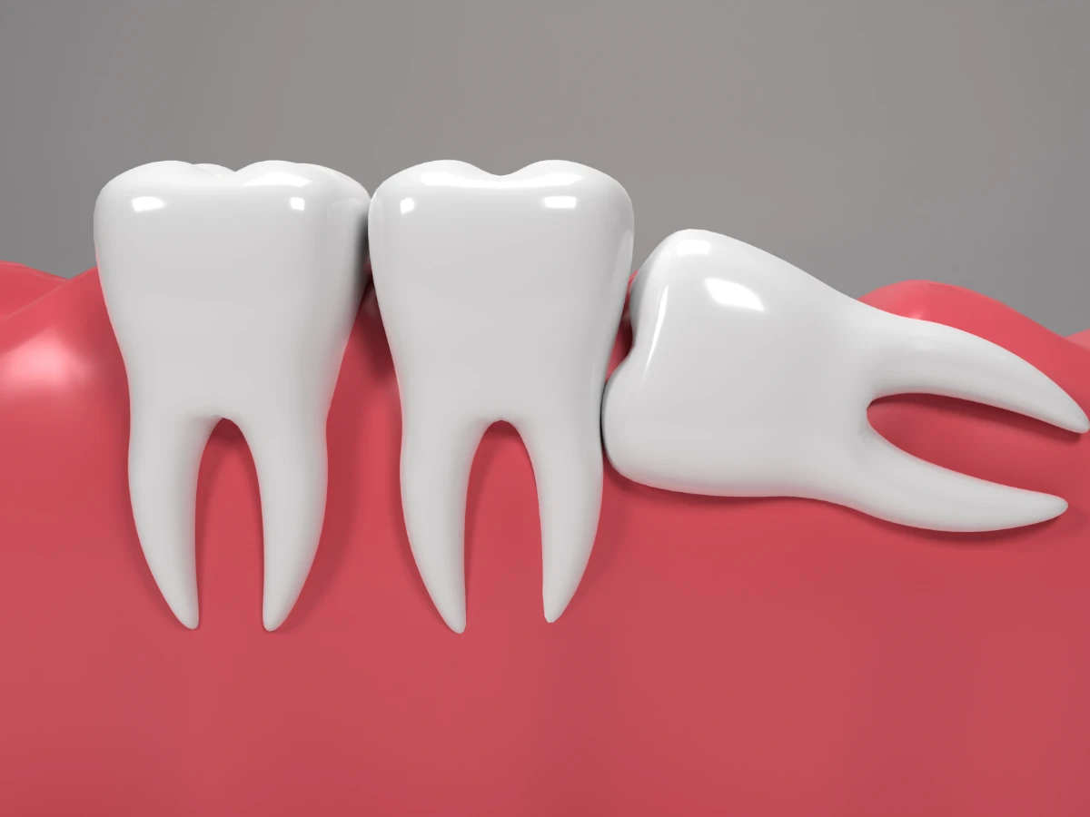 Зубы мудрости: как понять, что растут, нужно ли удалять