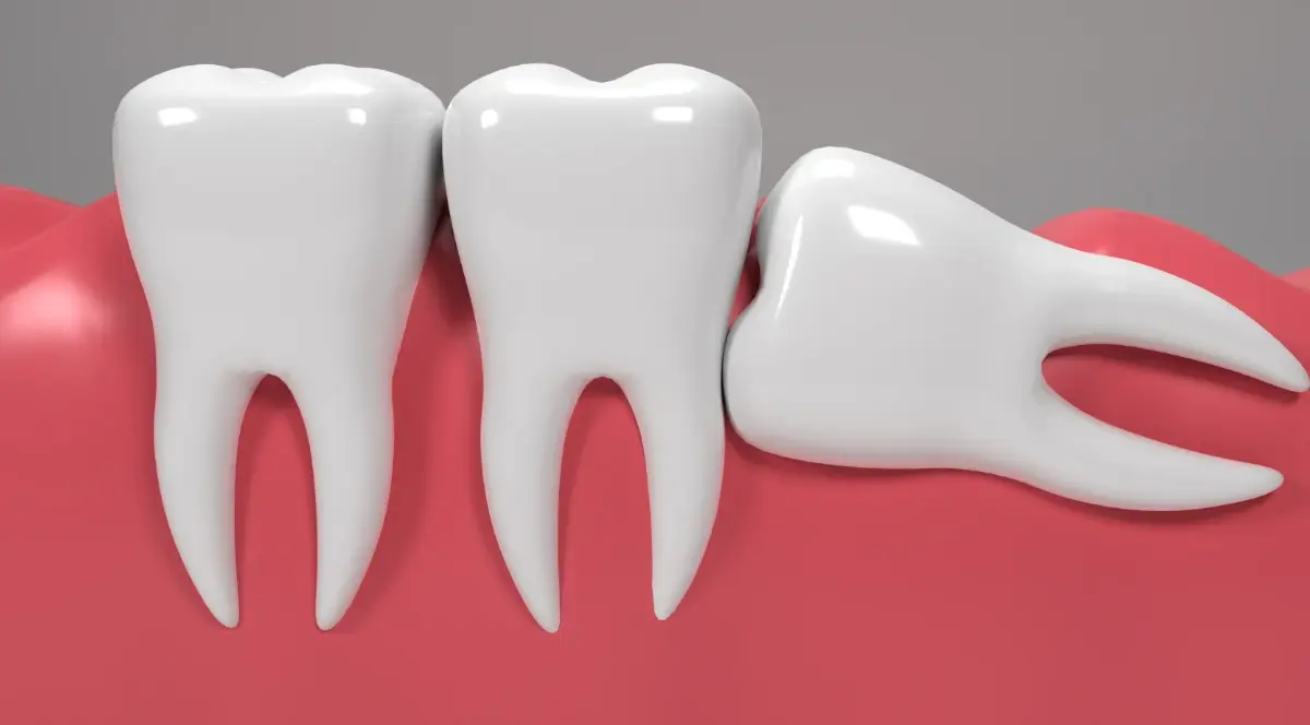 Зуби мудрості: як зрозуміти, що вони ростуть, чи потрібно їх видаляти