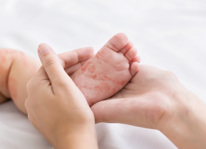 Алергія у дитини – що робити?