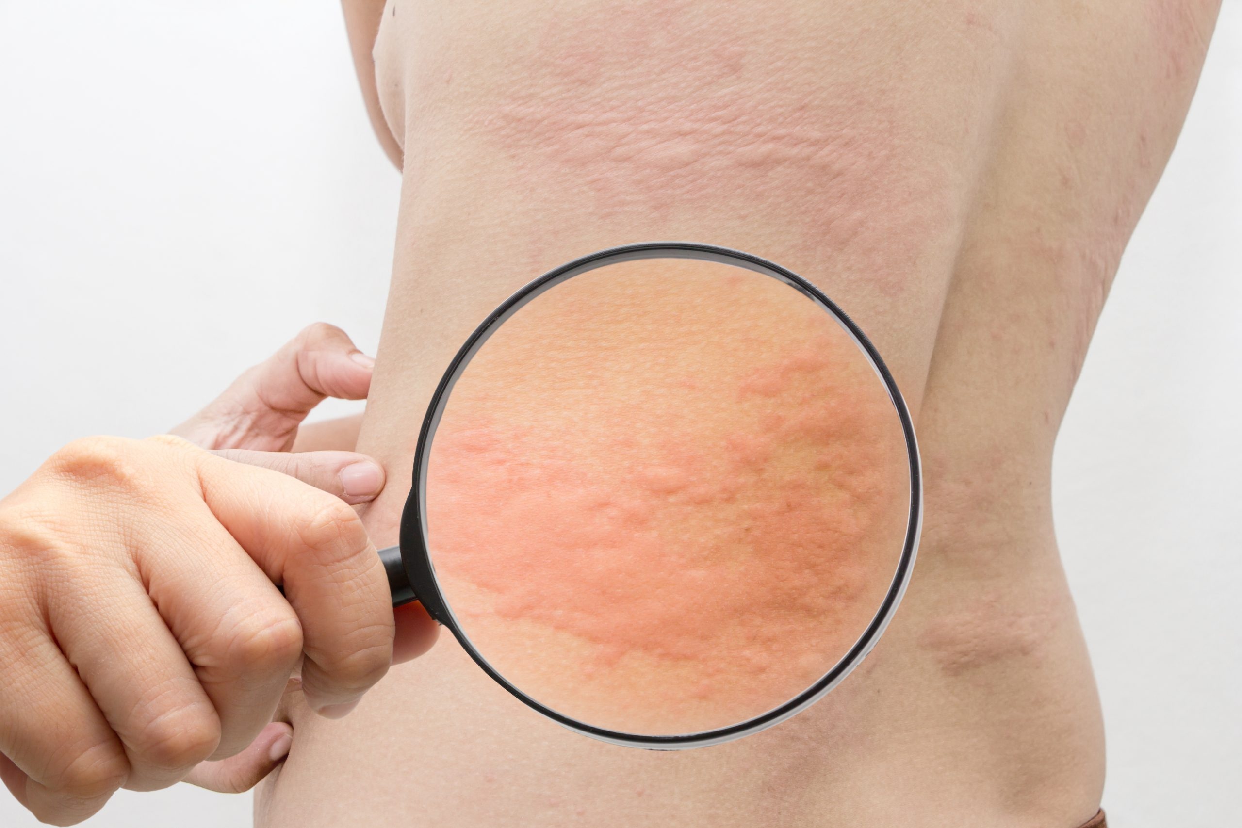 Аллергия на коже: лечение красных пятен и других проявлений