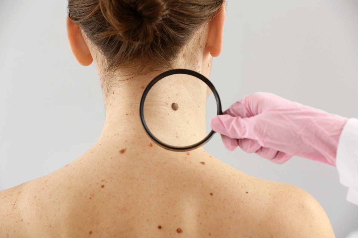 Травма родинки: может ли вызвать рак кожи и как оказать себе первую помощь