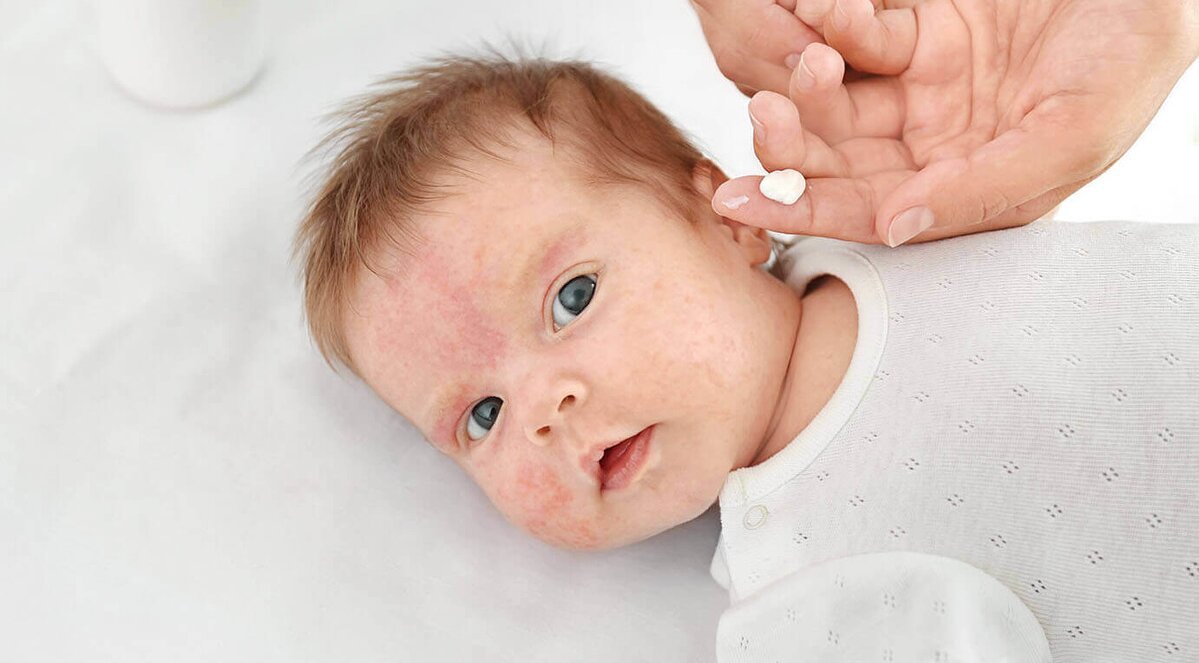 5 питань про атопічний дерматит у дитини
