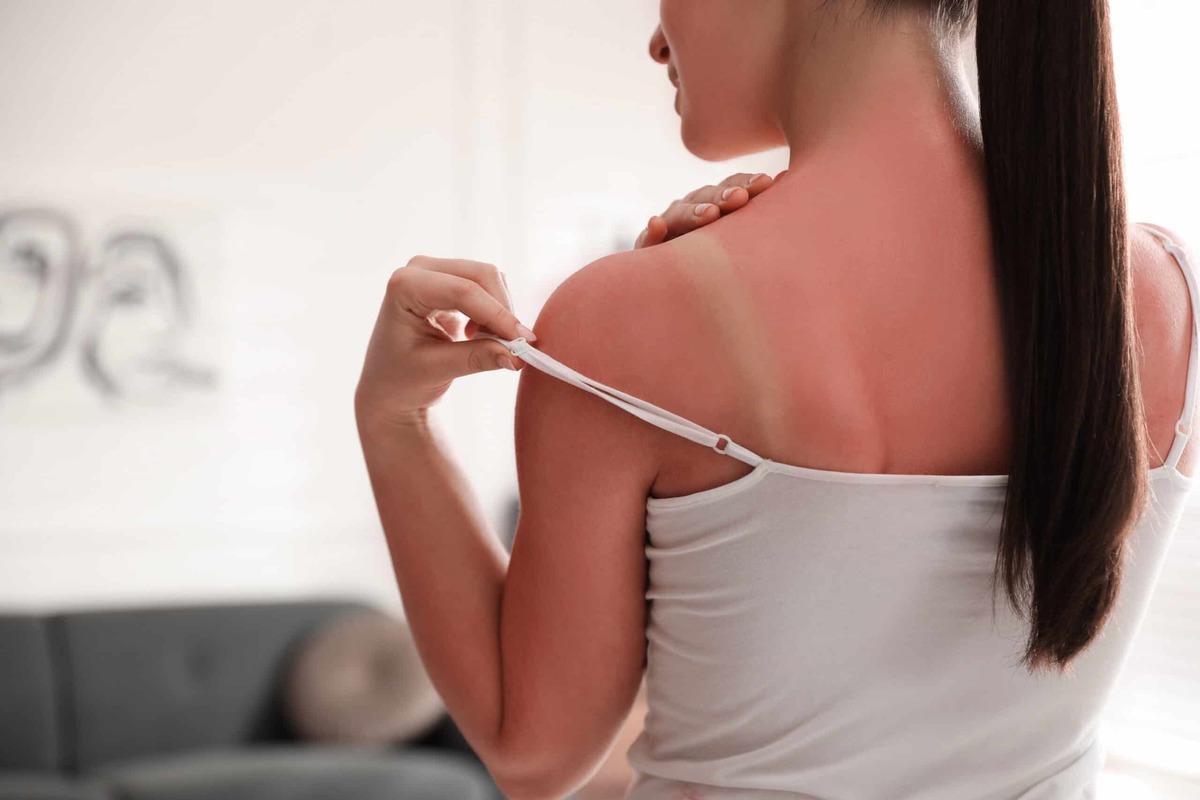 Аллергия на солнце: пятна на коже и причины фотодерматоза