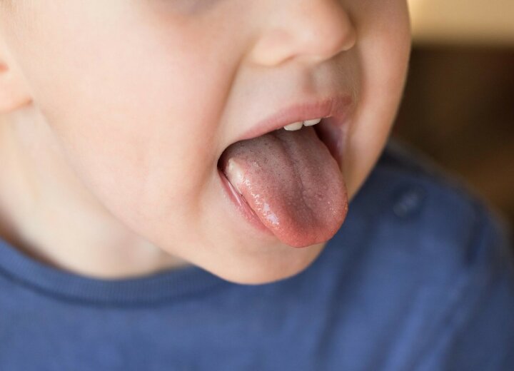 Як лікувати стоматит у дітей?