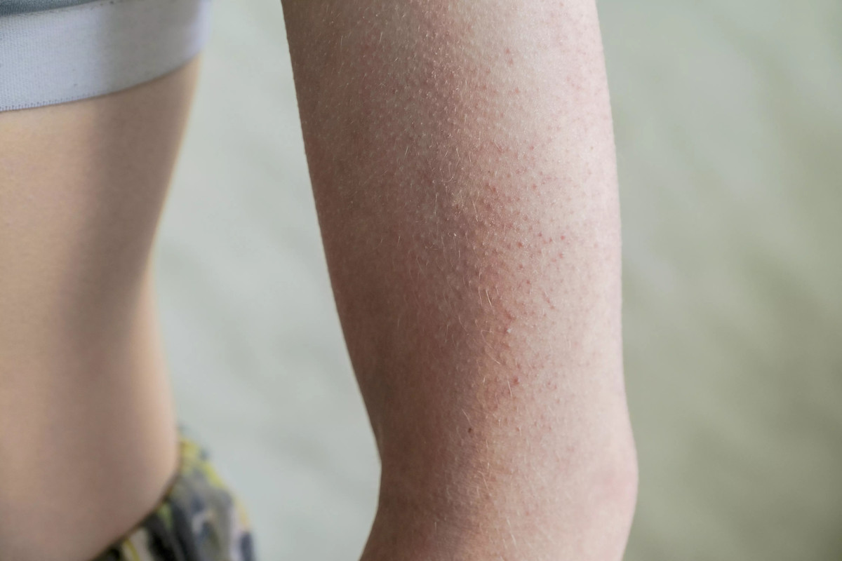Гиперкератоз кожи — что это, фото, симптомы и лечение