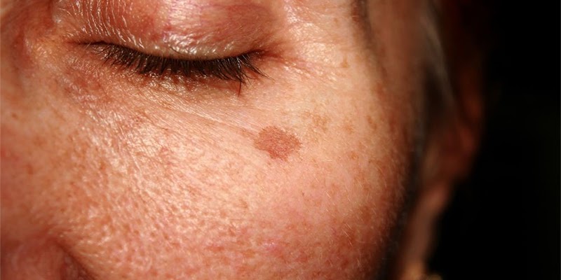 Причины появления пигментных пятен на лице