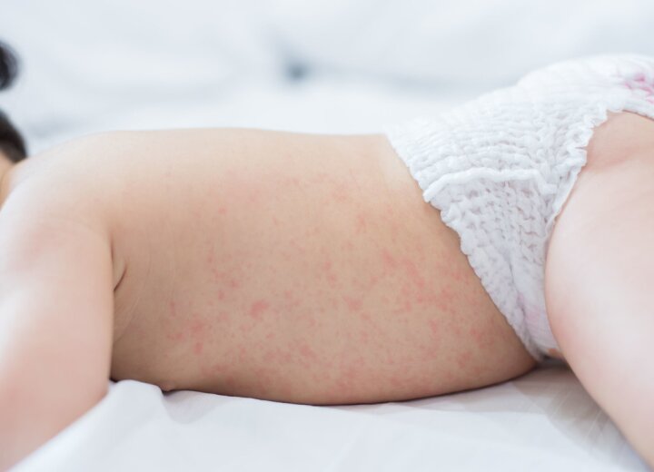 Как распознать и вылечить потницу у ребёнка?
