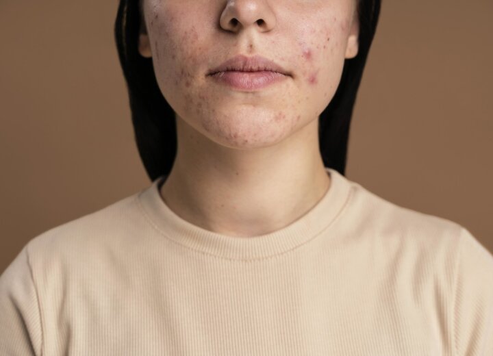 Причини виникнення та методи лікування демодекозу