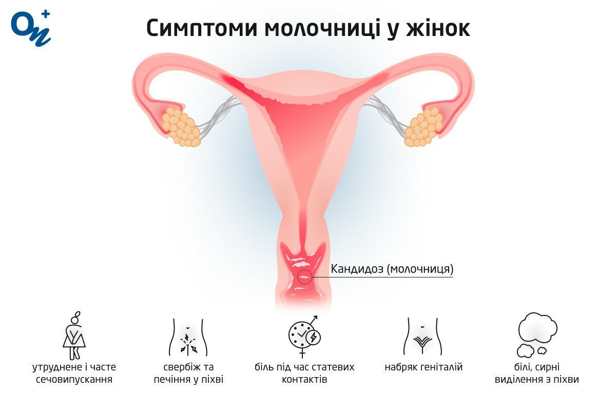 Симптоми молочниці у жінок