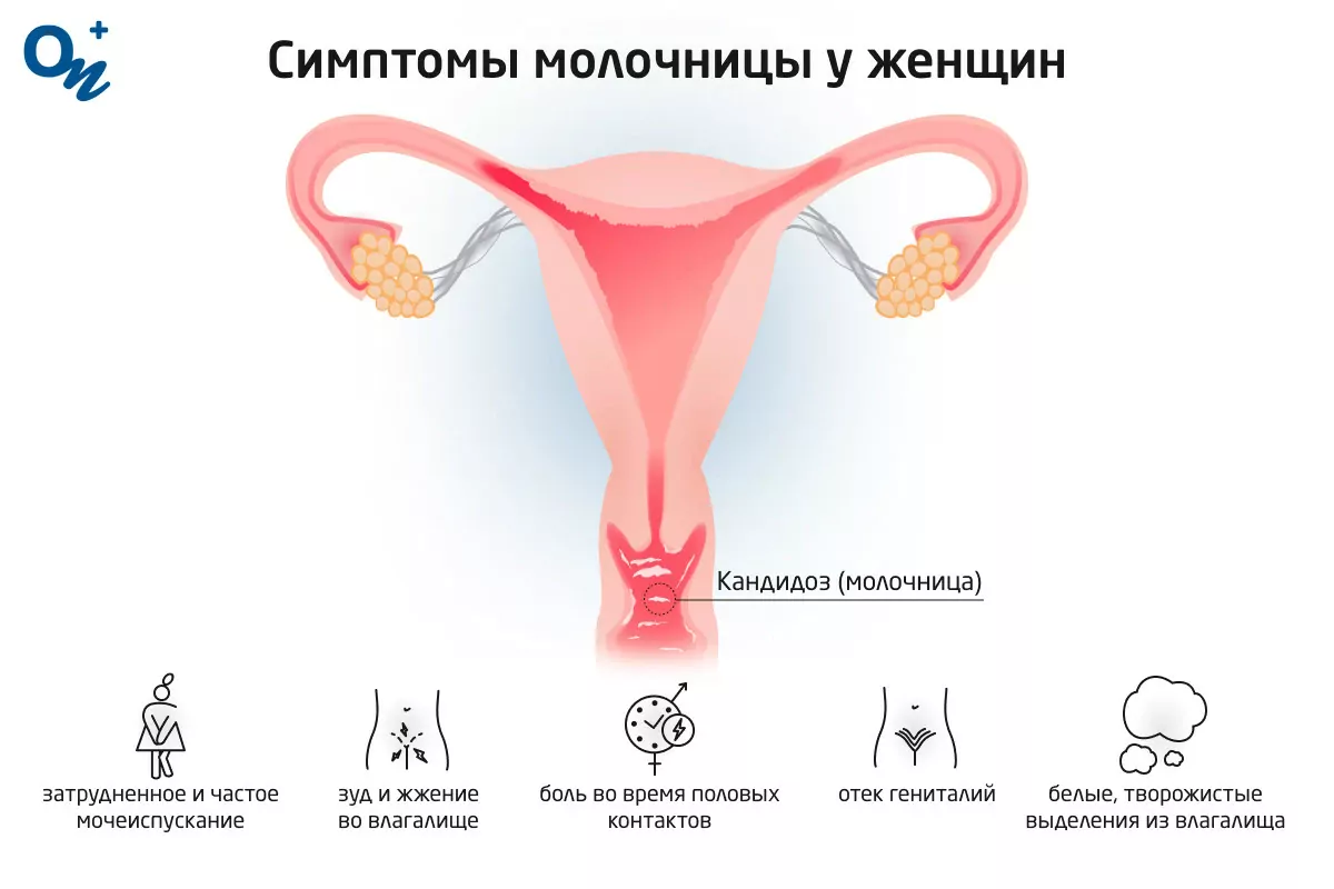 Молочница: симптомы, причины, диагностика, лечение и профилактика