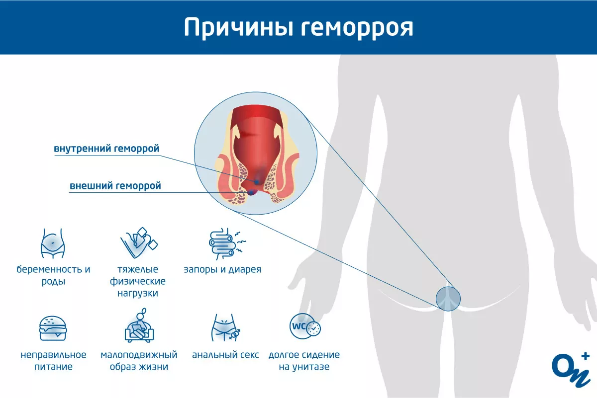 Лечение геморроя у мужчин