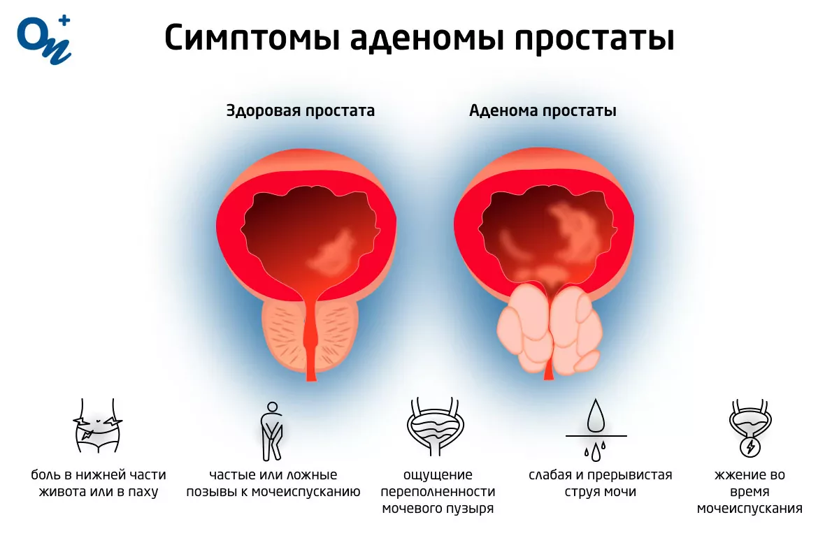 Массаж простаты