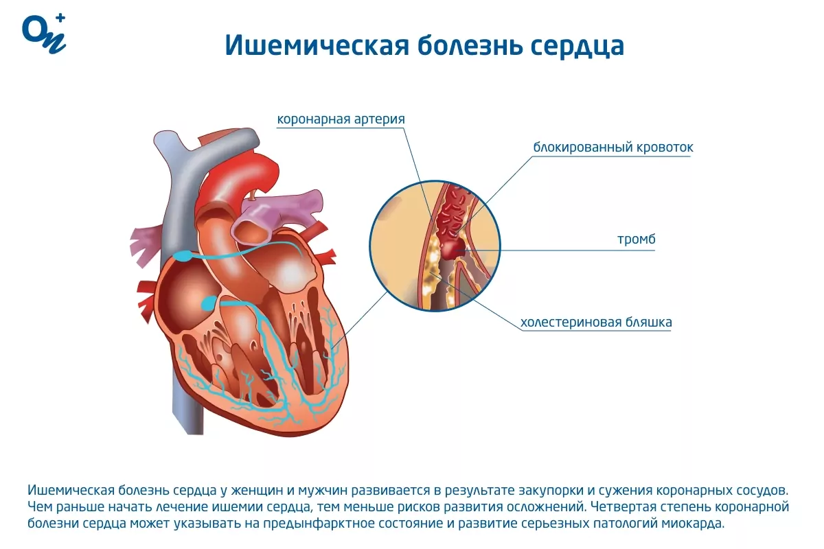 Что такое ишемическая болезнь сердца?