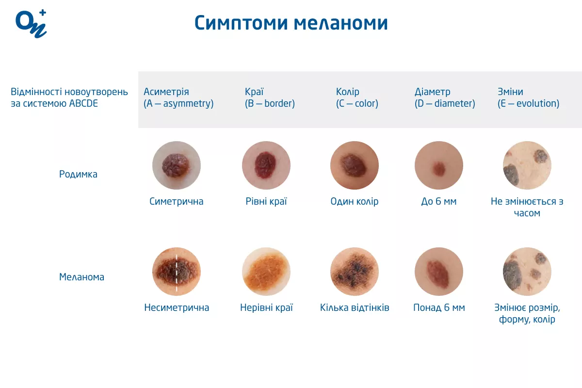 Симптоми меланоми