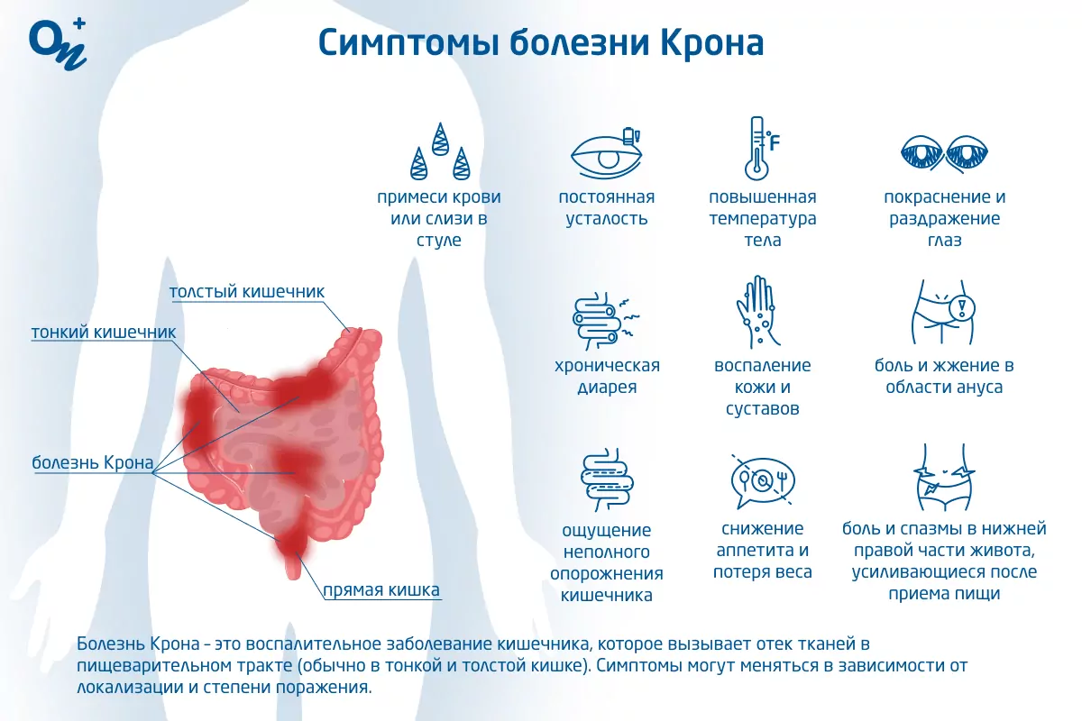 Болезнь Крона: симптомы, причины, диагностика, лечение и профилактика