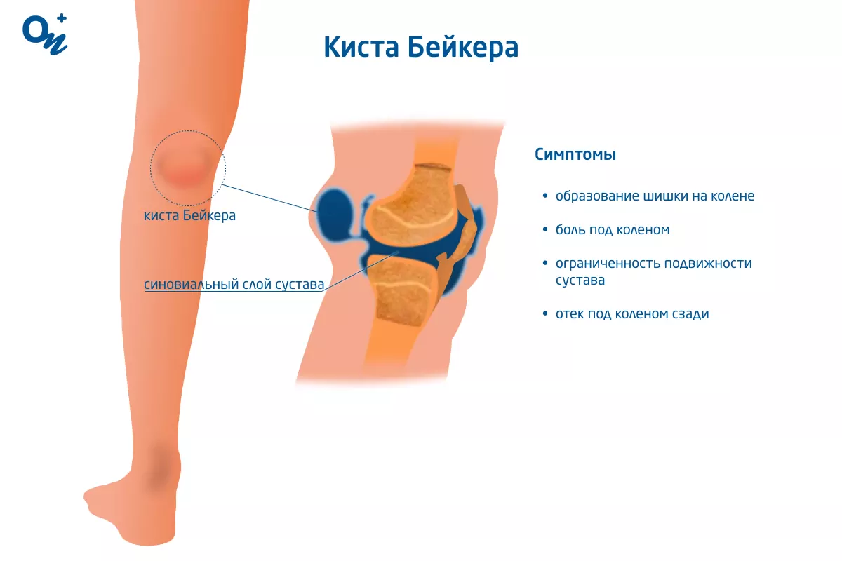 Киста Бейкера (подколенная киста)