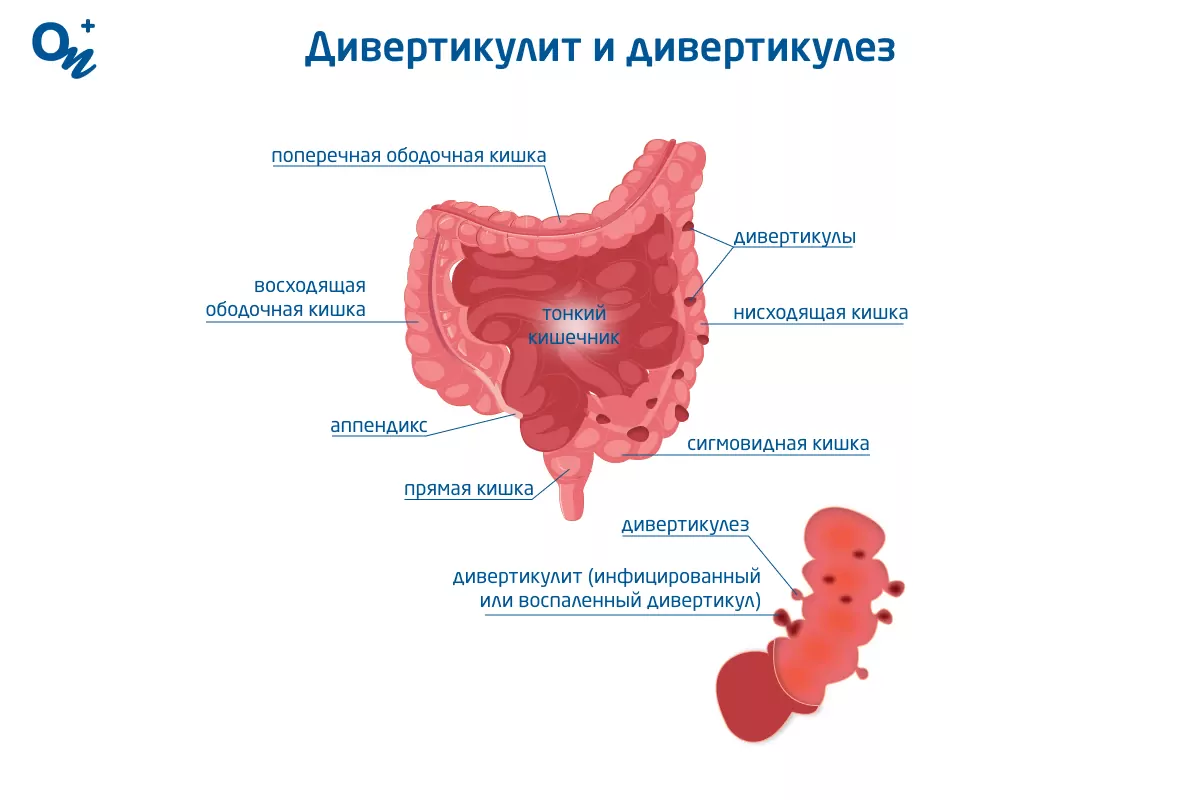 Заворот кишок