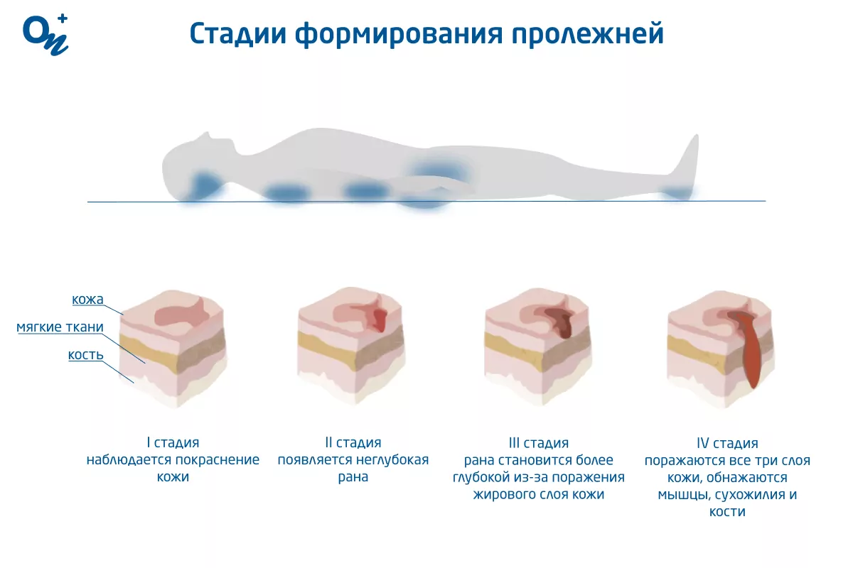 • Товары по назначению Лечение глубоких пролежней