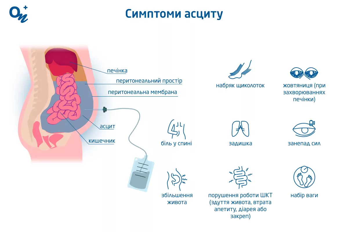 Симптоми асциту