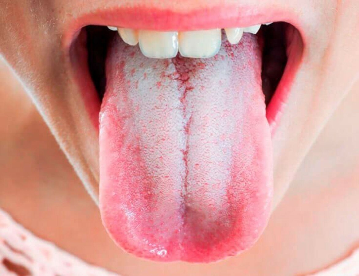 хелікобактер на язиці