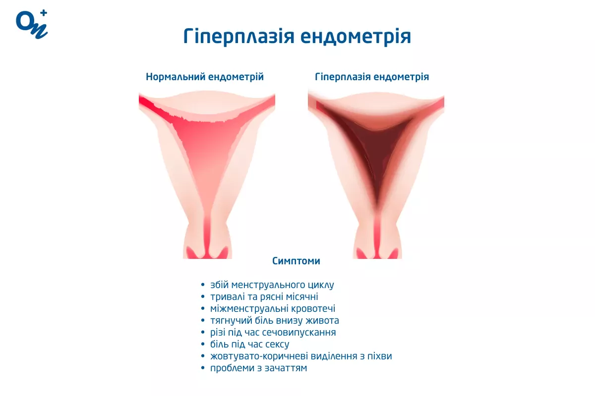Гіперплазія ендометрія