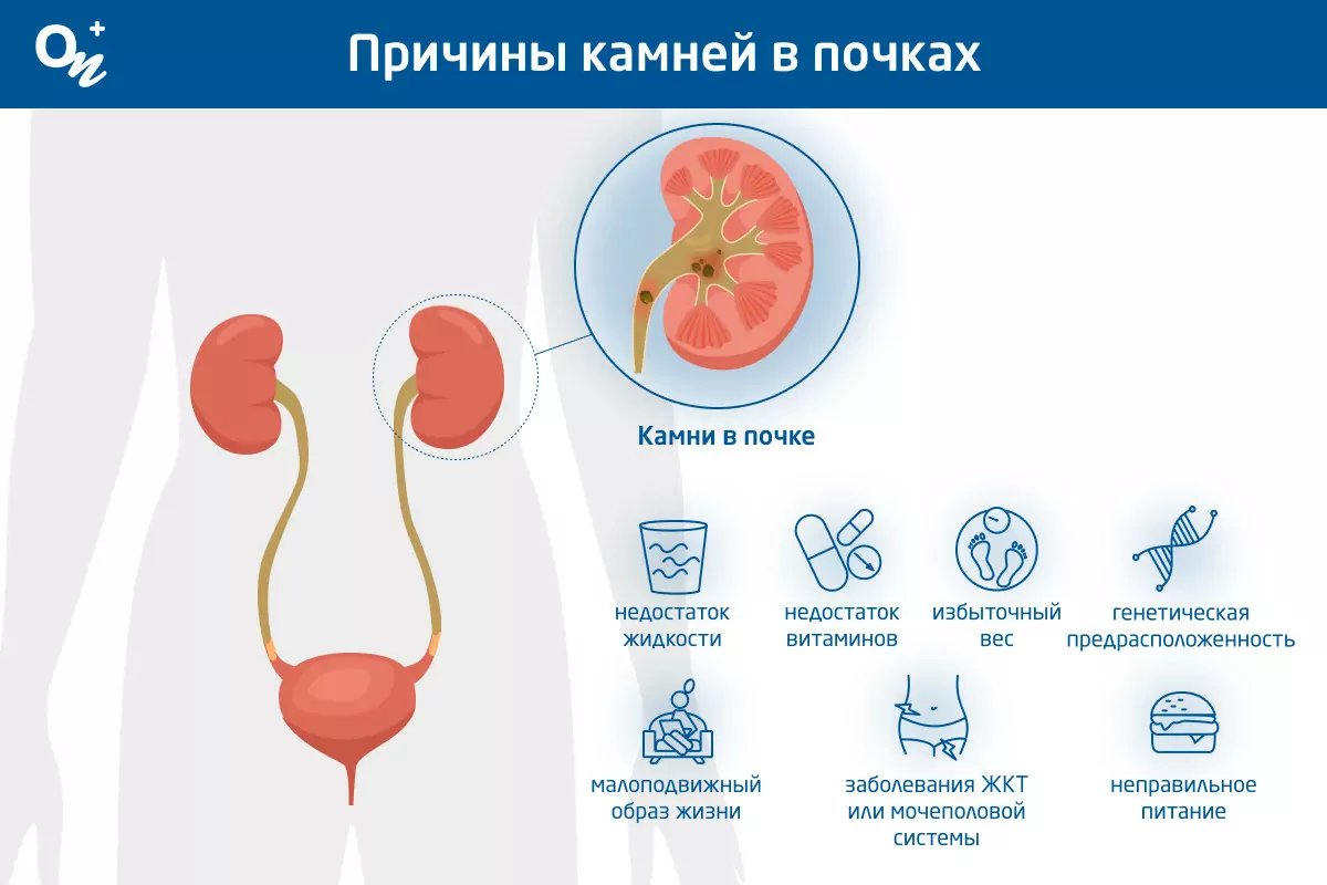 Как пройти камень мочеточника? - Серхат Донмезер