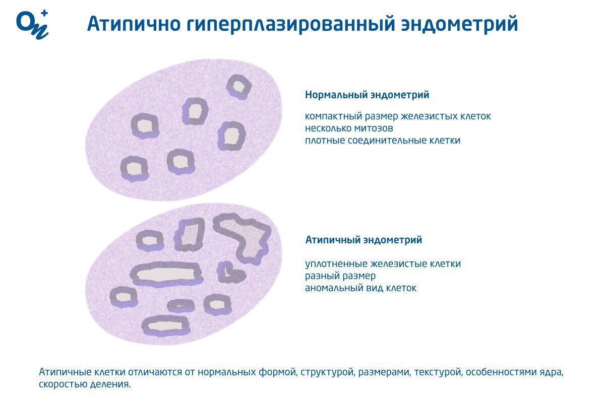 Что такое атипическая гиперплазия эндометрия — блог медицинского центра ОН  Клиник