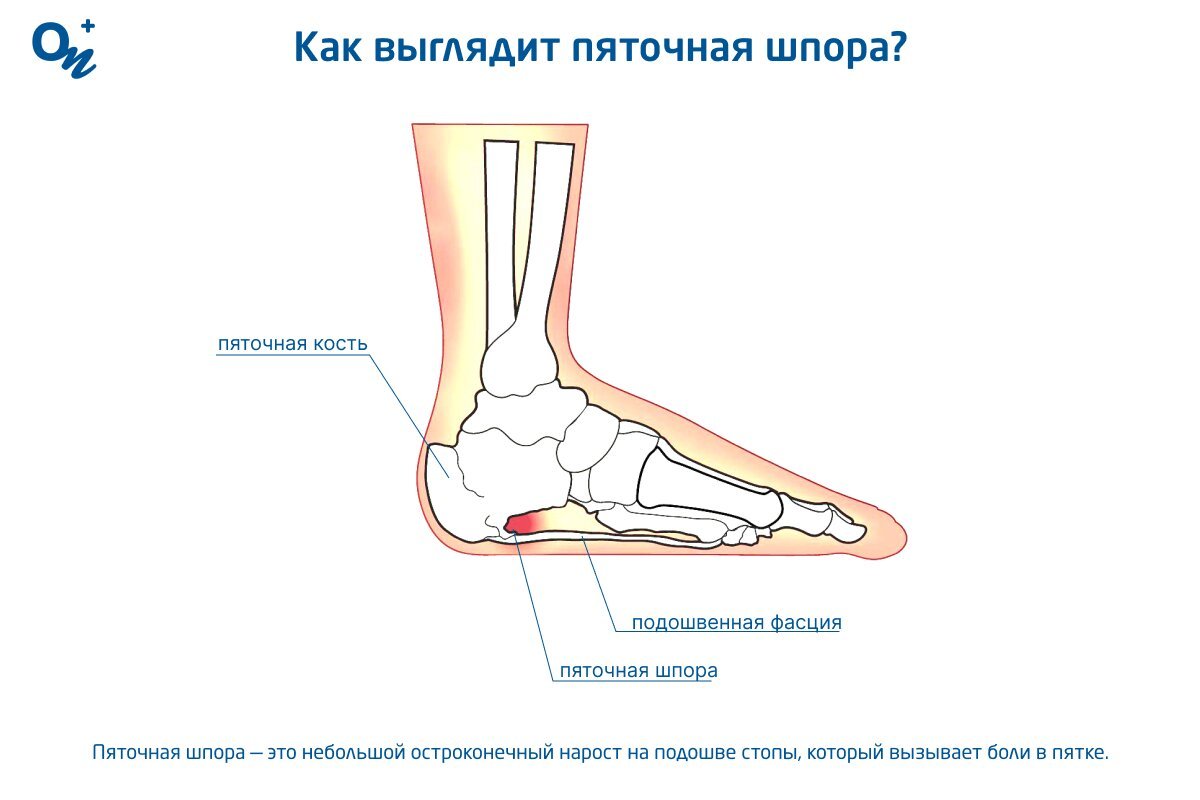 Лечение пяточной шпоры с помощью народных средств